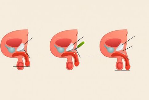 înainte și după operația de mărire a penisului